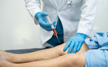 Imagem em Destaque - Fleboestética em Manaus: atendimento exclusivo para saúde vascular