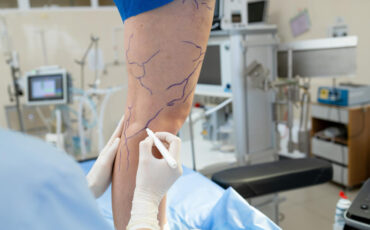 Imagem em Destaque - Angiologista em Manaus: médico vascular especialista no tratamento de varizes