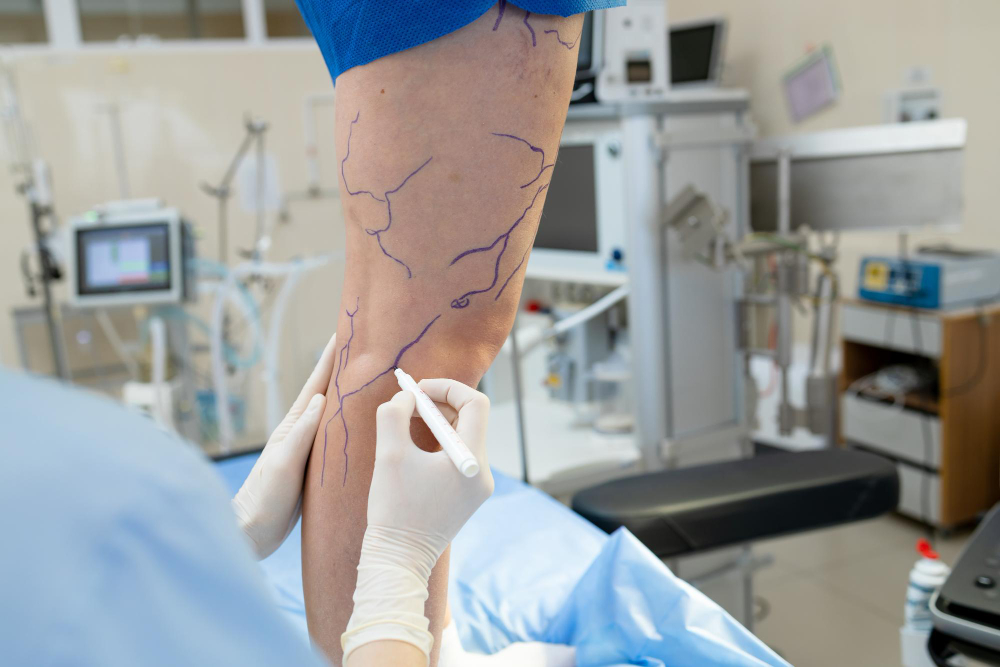 Angiologista em Manaus: médico vascular especialista no tratamento de varizes