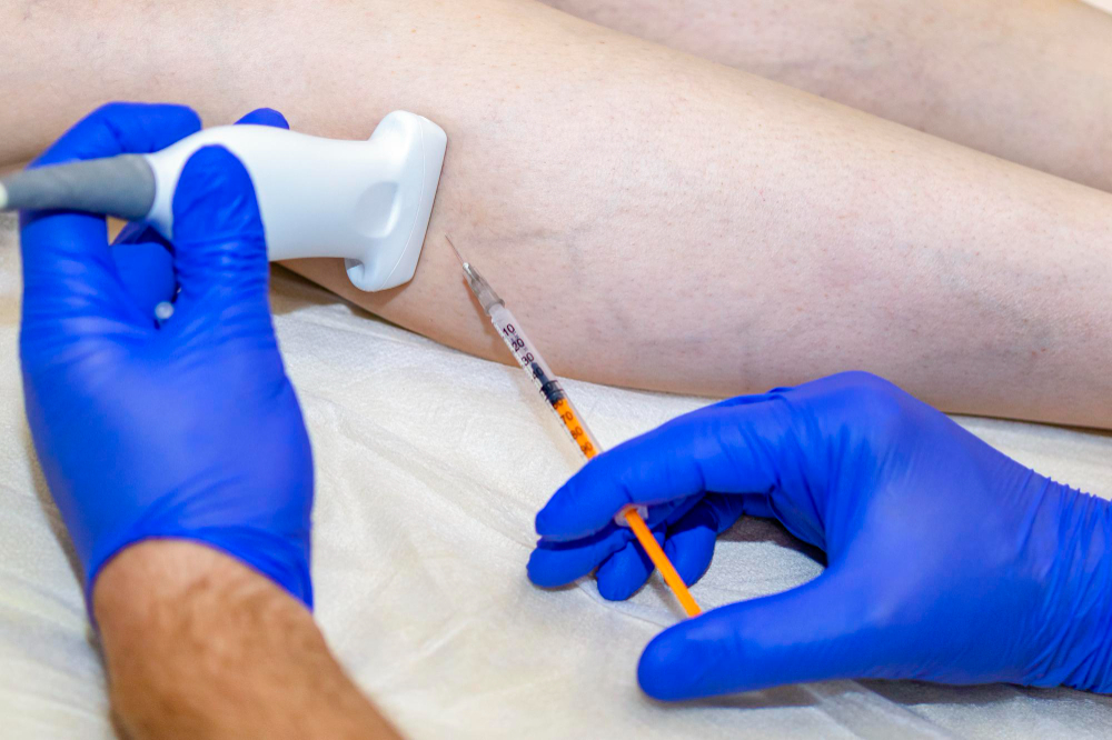 Escleroterapia para varizes em Manaus: quanto custa e como iniciar o tratamento