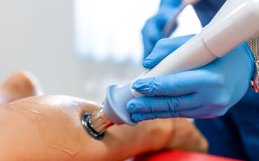 Imagem em Destaque - Tratamento de varizes com espuma densa: técnica moderna para tratar varizes sem cirurgia, com mais conforto e rápida recuperação