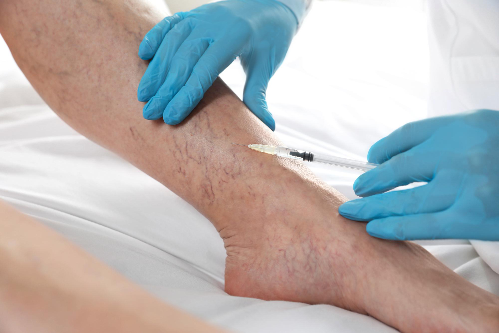 Escleroterapia em Manaus: saiba quando este tratamento é indicado para eliminar vasinhos e microvarizes