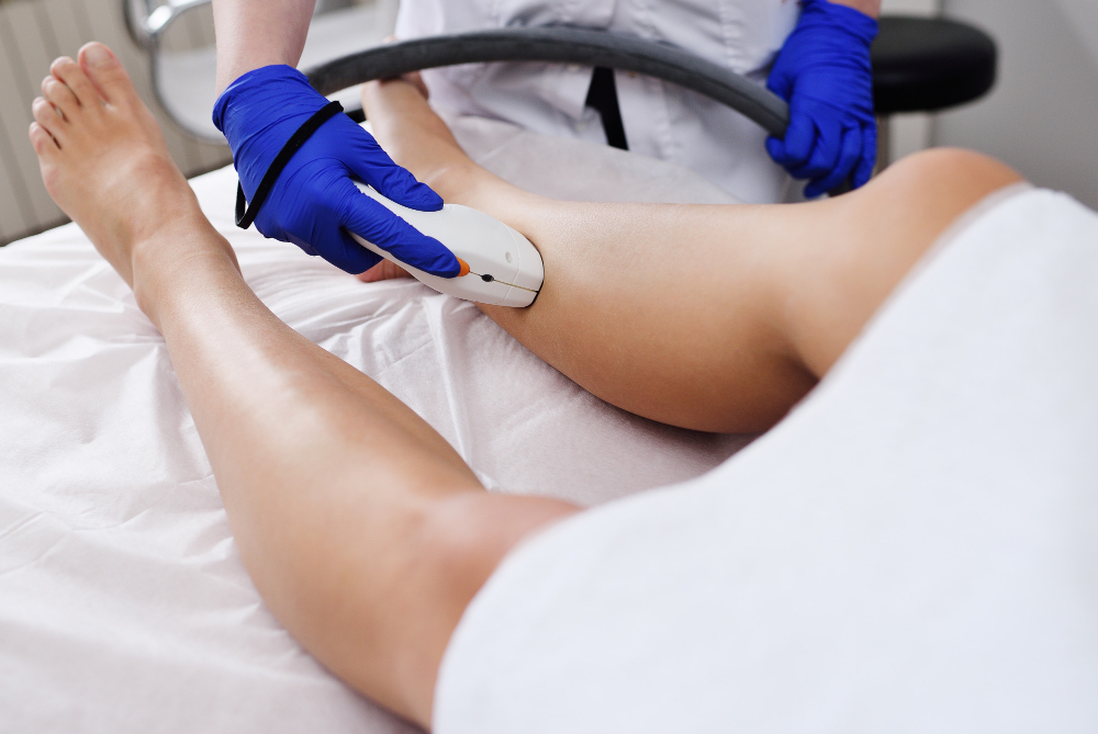 Escleroterapia a laser em Manaus: descubra quando esta técnica é a melhor opção para tratar os vasinhos