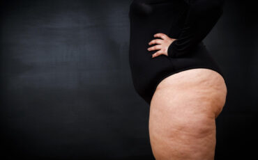 Imagem em Destaque - Cirurgia vascular lipedema em Manaus: entenda as possibilidades de tratamento e onde procurar avaliação especializada