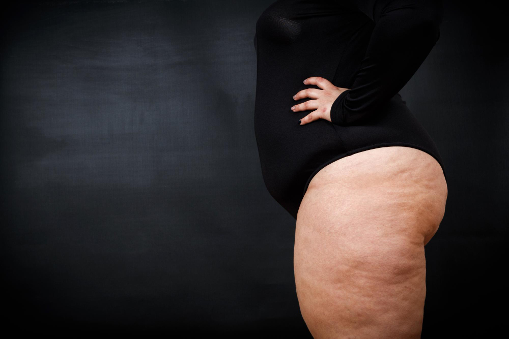 Cirurgia vascular lipedema em Manaus: entenda as possibilidades de tratamento e onde procurar avaliação especializada