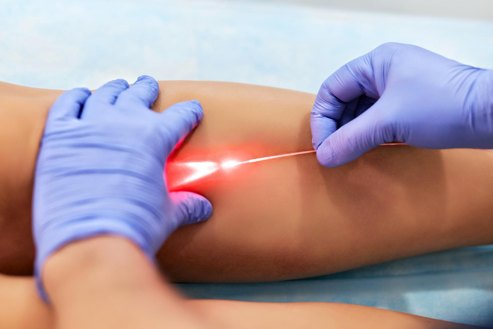Laser endovenoso em Manaus: tecnologia minimamente invasiva para tratar varizes e melhorar a circulação